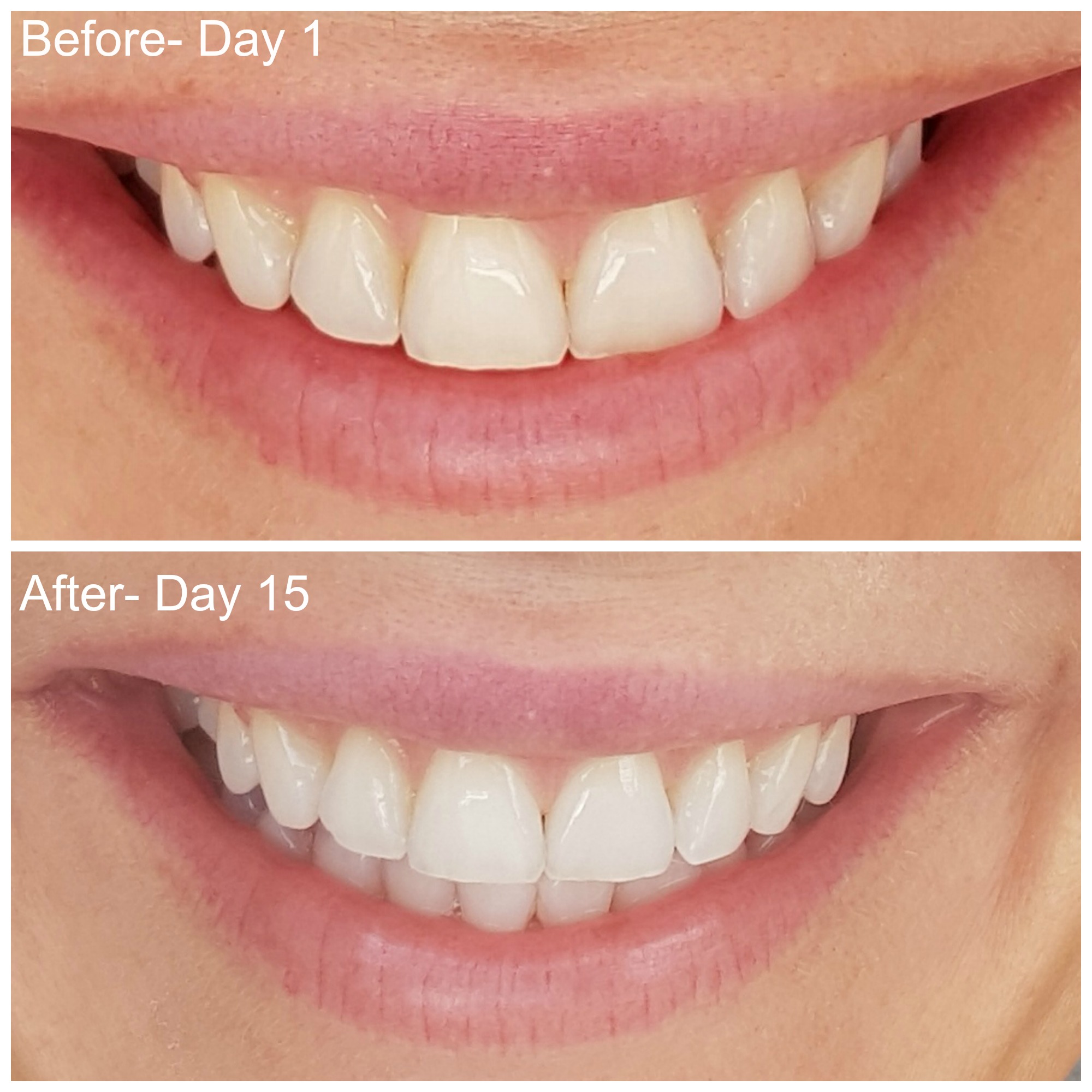 Smile Brilliant before and after teeth whitening at home results
